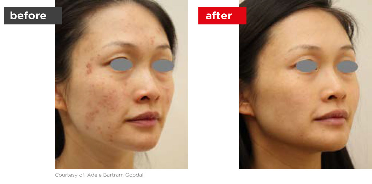 Acne-Before_Afters-1 Acne-Before_Afters-1