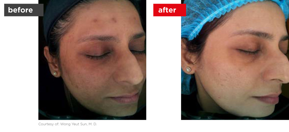 Acne-Before_Afters-10 Acne-Before_Afters-10