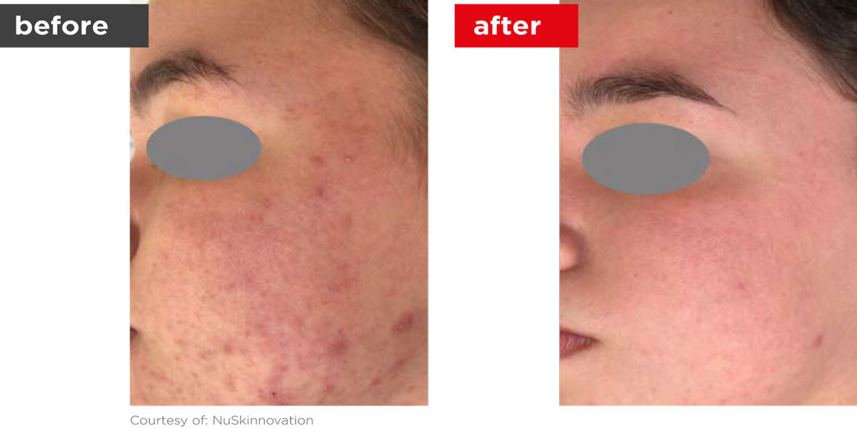 Acne-Before_Afters-12 Acne-Before_Afters-12