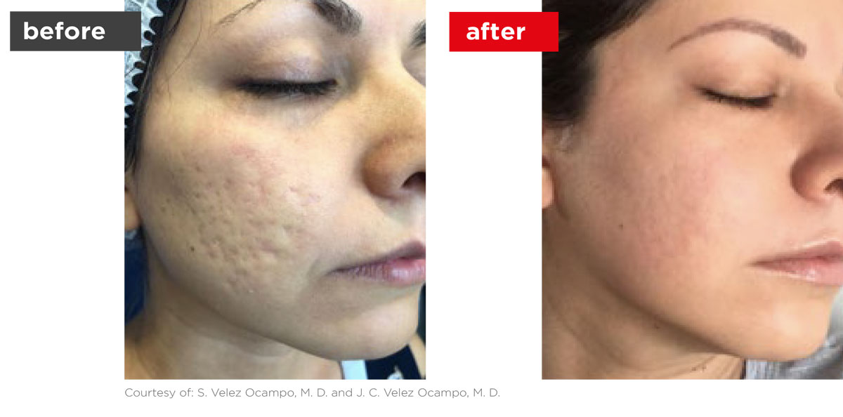 Acne-Before_Afters-2 Acne-Before_Afters-2