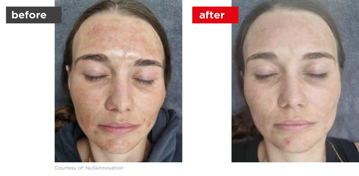 Acne-Before_Afters-5 Acne-Before_Afters-5