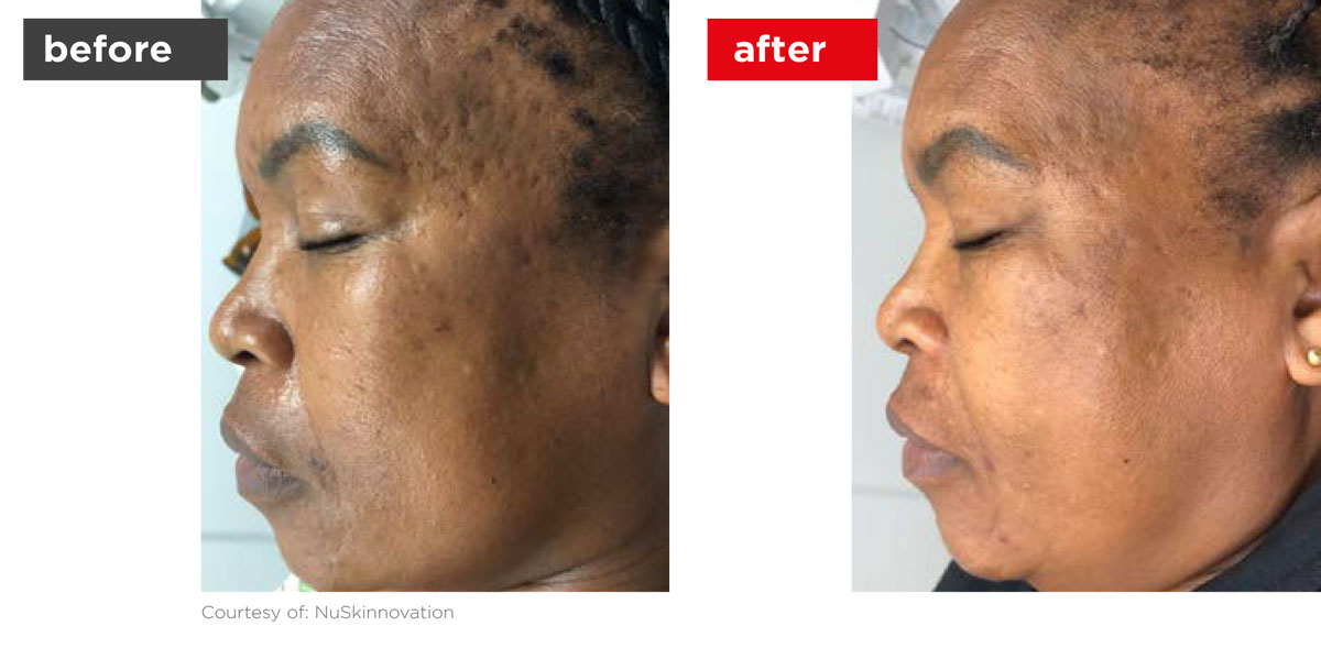 Acne-Before_Afters-6 Acne-Before_Afters-6