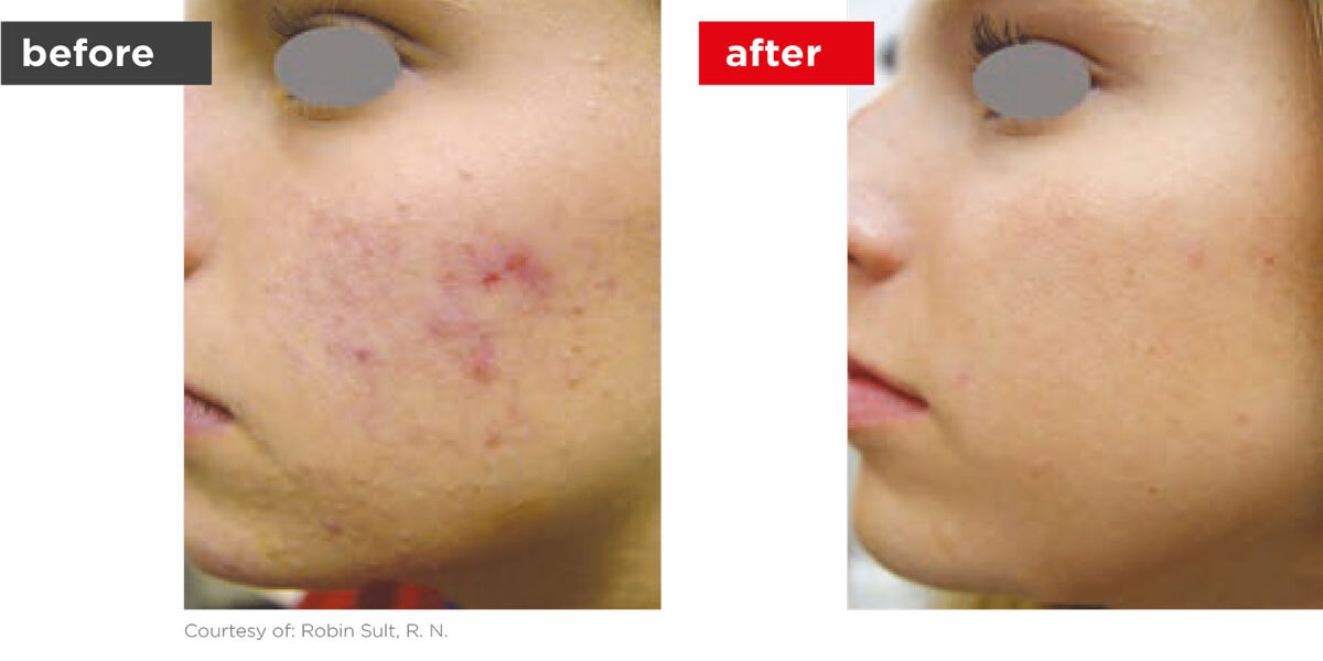 Acne-Before_Afters-7 Acne-Before_Afters-7