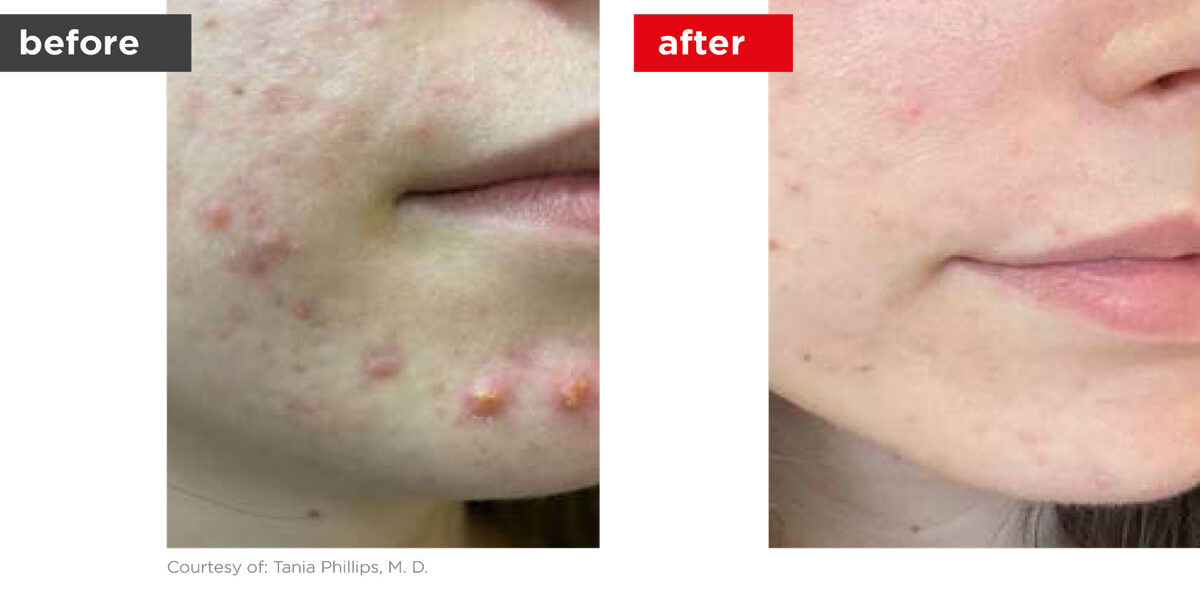 Acne-Before_Afters-8 Acne-Before_Afters-8