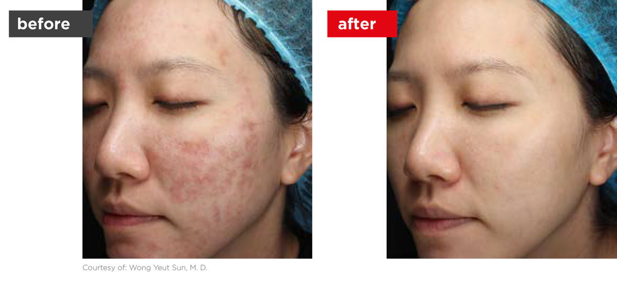 Acne-Before_Afters-9 Acne-Before_Afters-9