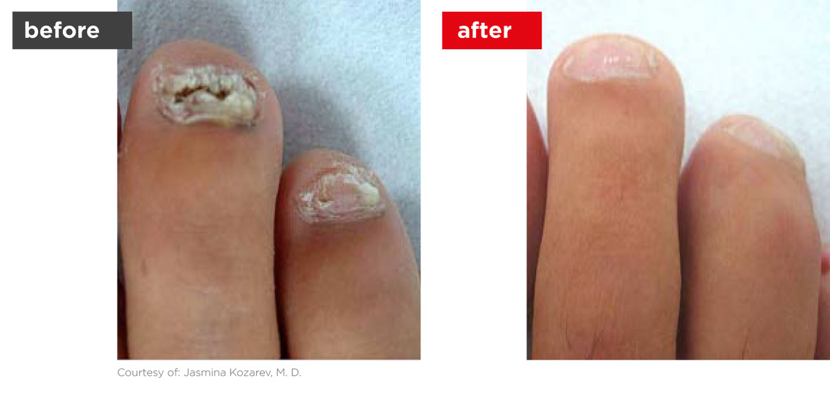 ClearSteps-Before_After-2 ClearSteps-Before_After-2