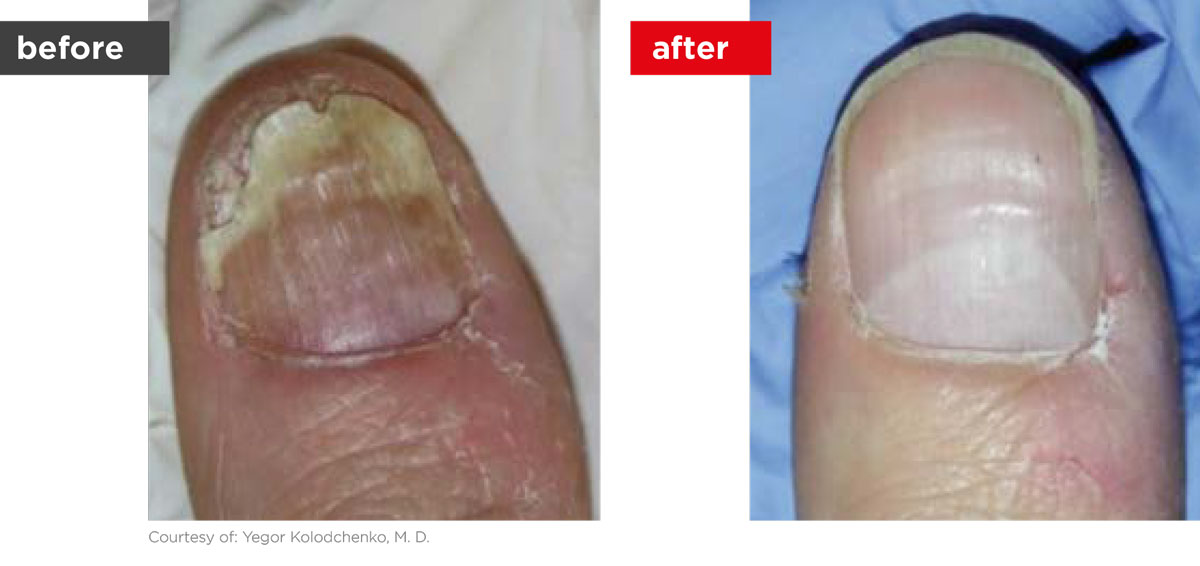 ClearSteps-Before_After-3 ClearSteps-Before_After-3