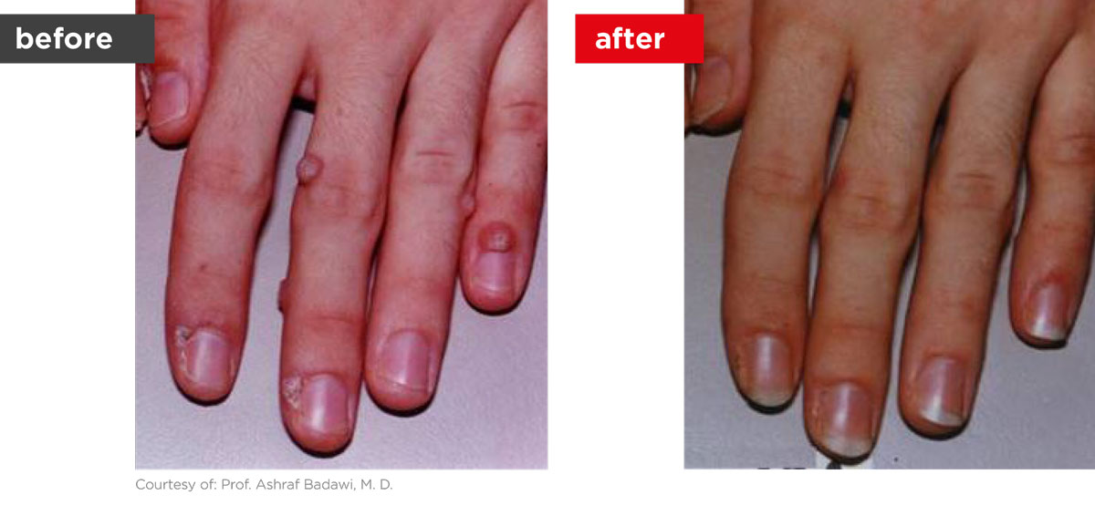 ClearSteps-Before_After-4 ClearSteps-Before_After-4