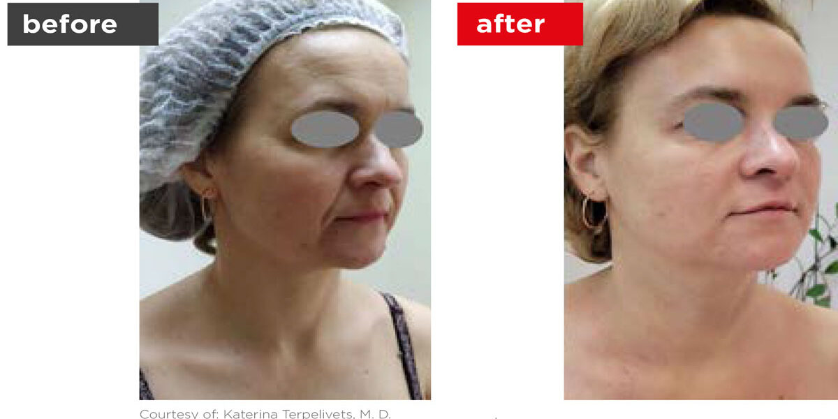 Fotona4D-Before_After-1 Fotona4D-Before_After-1