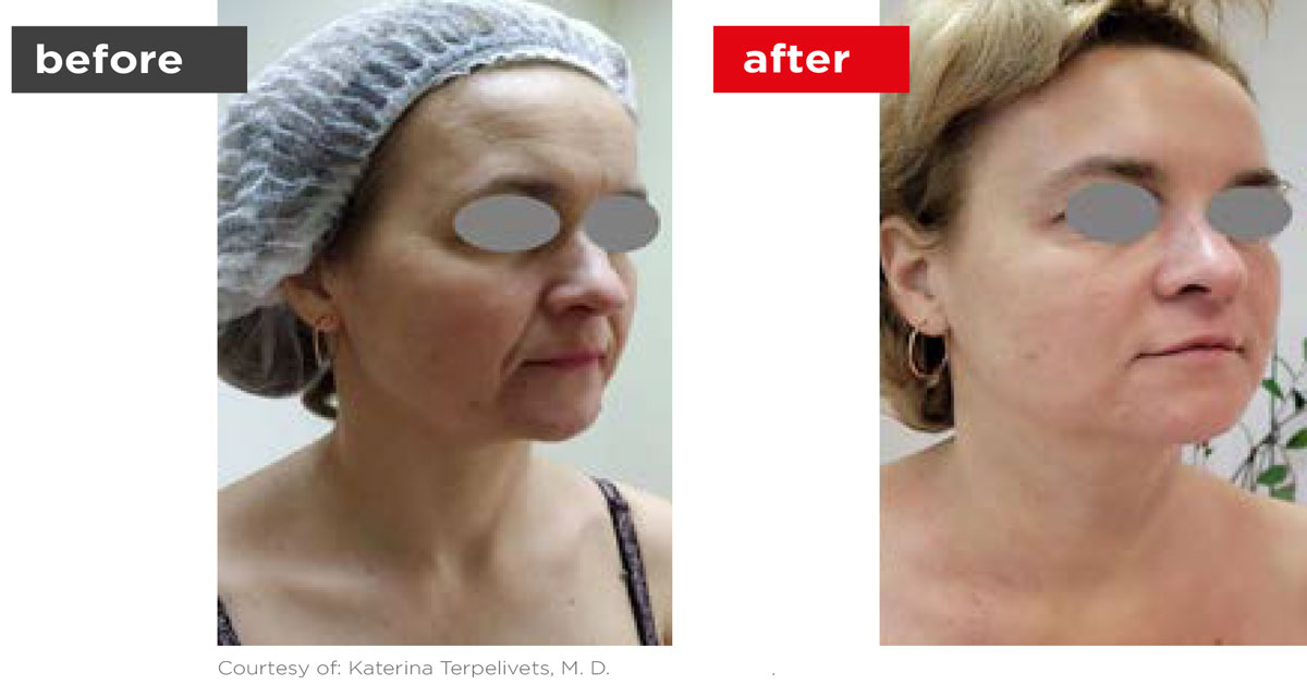 Fotona4D-Before_After-1