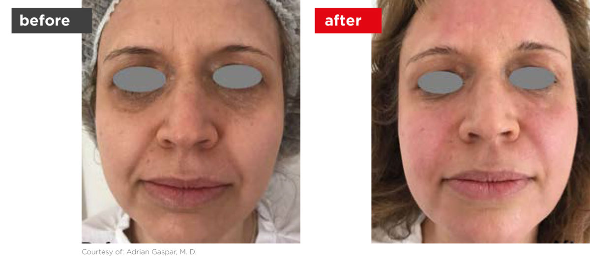 Fotona4D-Before_After-10