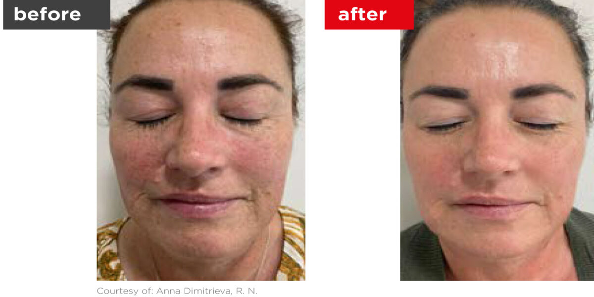 Fotona4D-Before_After-2 Fotona4D-Before_After-2