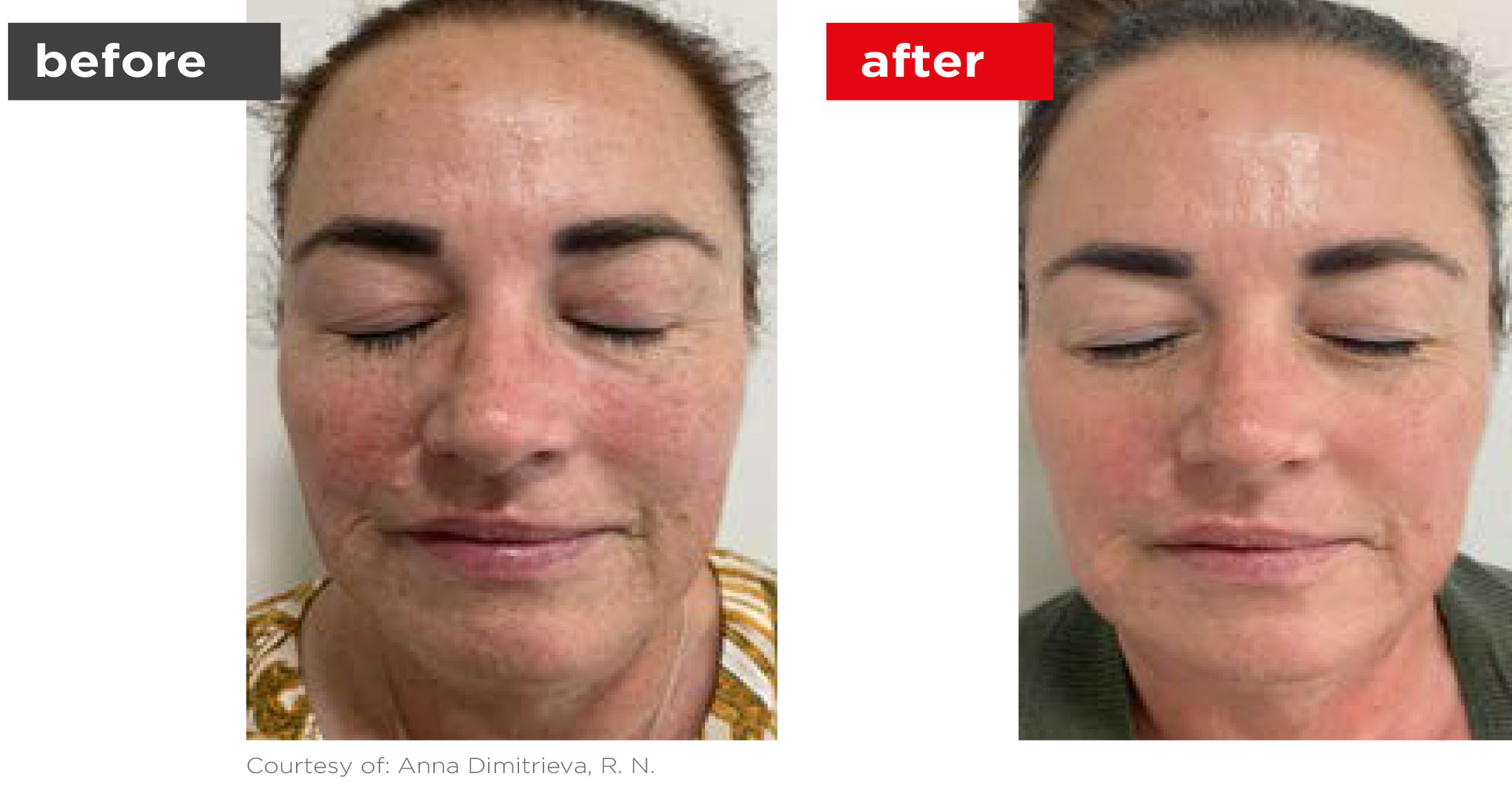 Fotona4D-Before_After-2