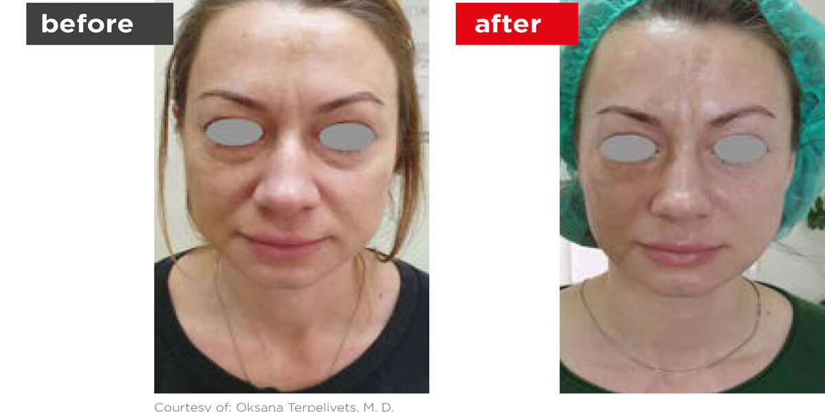 Fotona4D-Before_After-3 Fotona4D-Before_After-3