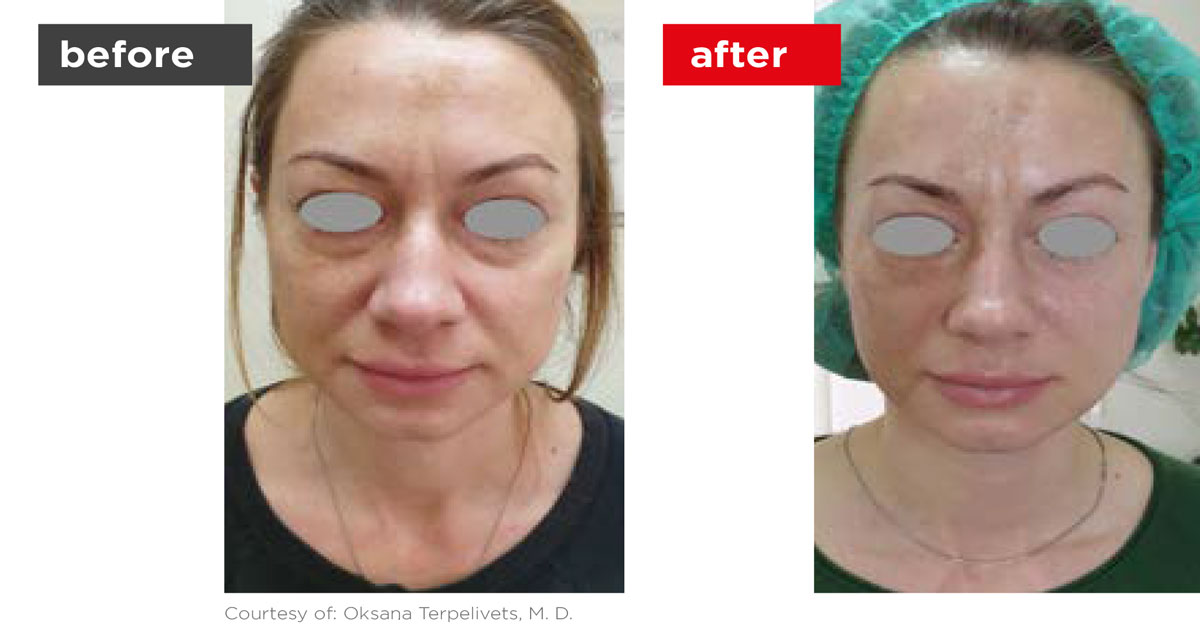 Fotona4D-Before_After-3