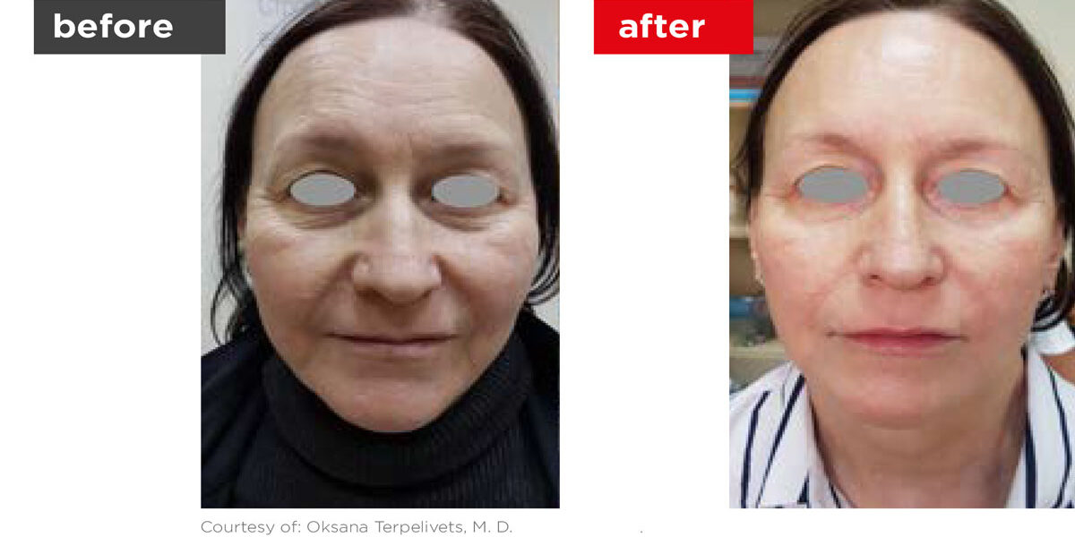 Fotona4D-Before_After-4 Fotona4D-Before_After-4