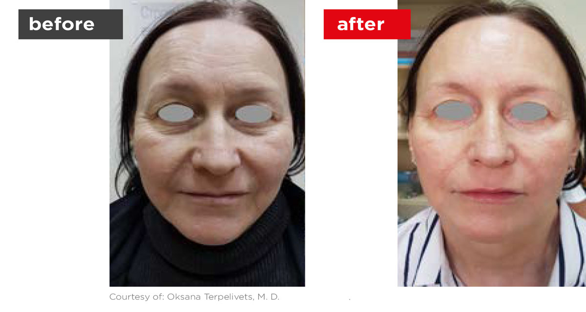 Fotona4D-Before_After-4