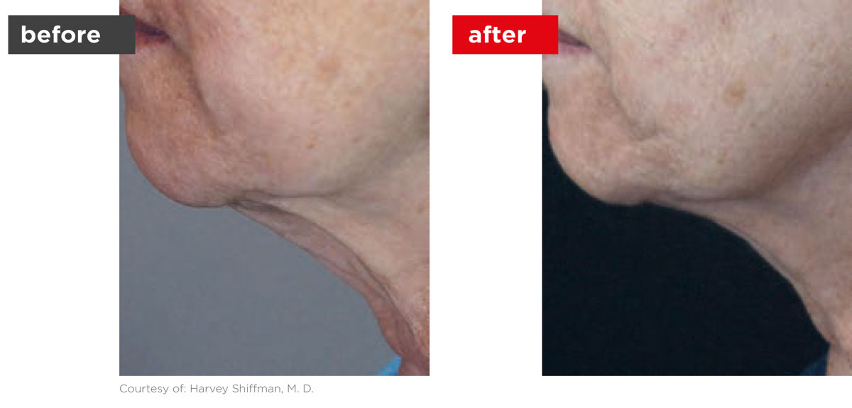 Fotona4D-Before_After-5