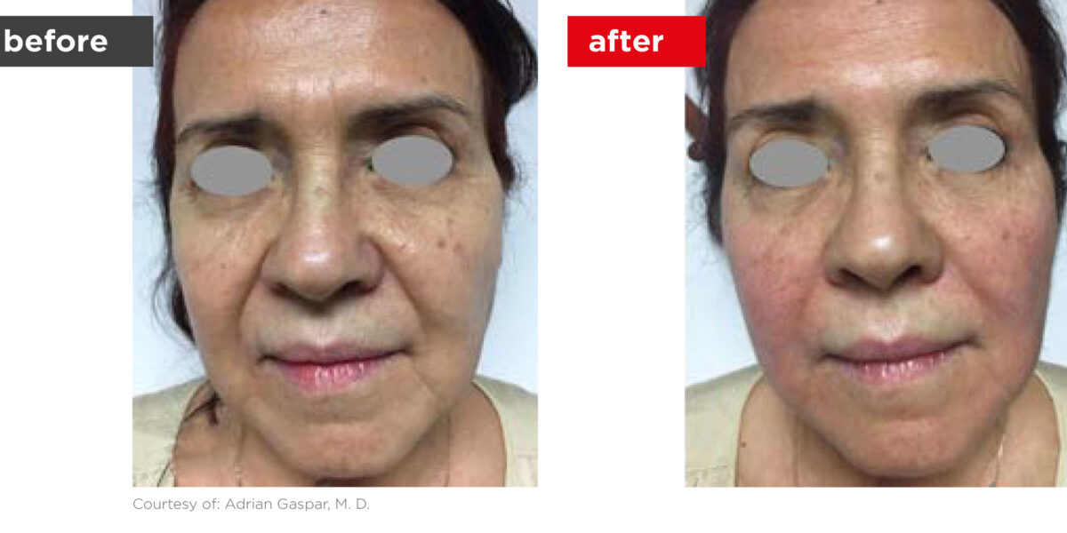 Fotona4D-Before_After-6 Fotona4D-Before_After-6