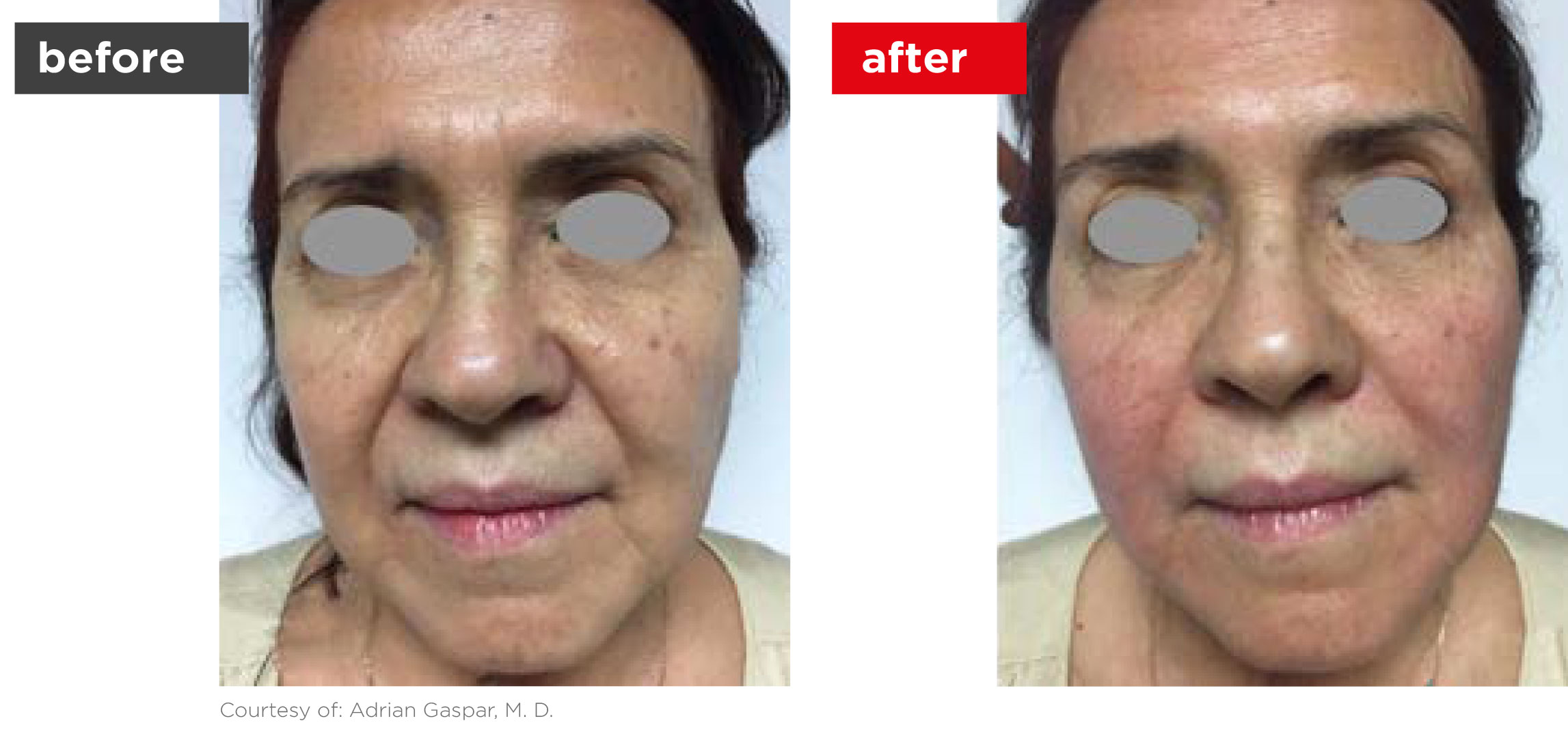 Fotona4D-Before_After-6