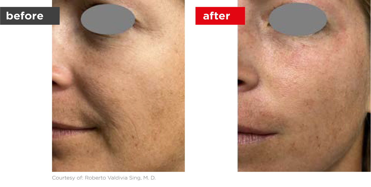 Fotona4D-Before_After-7