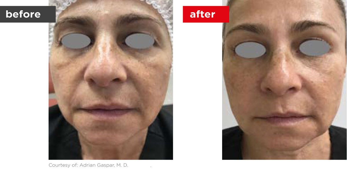 Fotona4D-Before_After-8 Fotona4D-Before_After-8