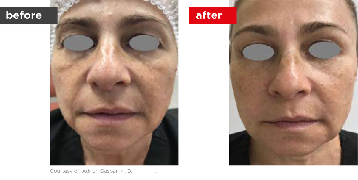 Fotona4D-Before_After-8