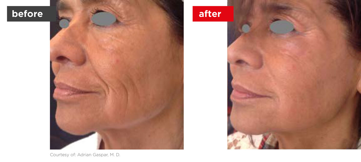 Fotona4D-Before_After-9