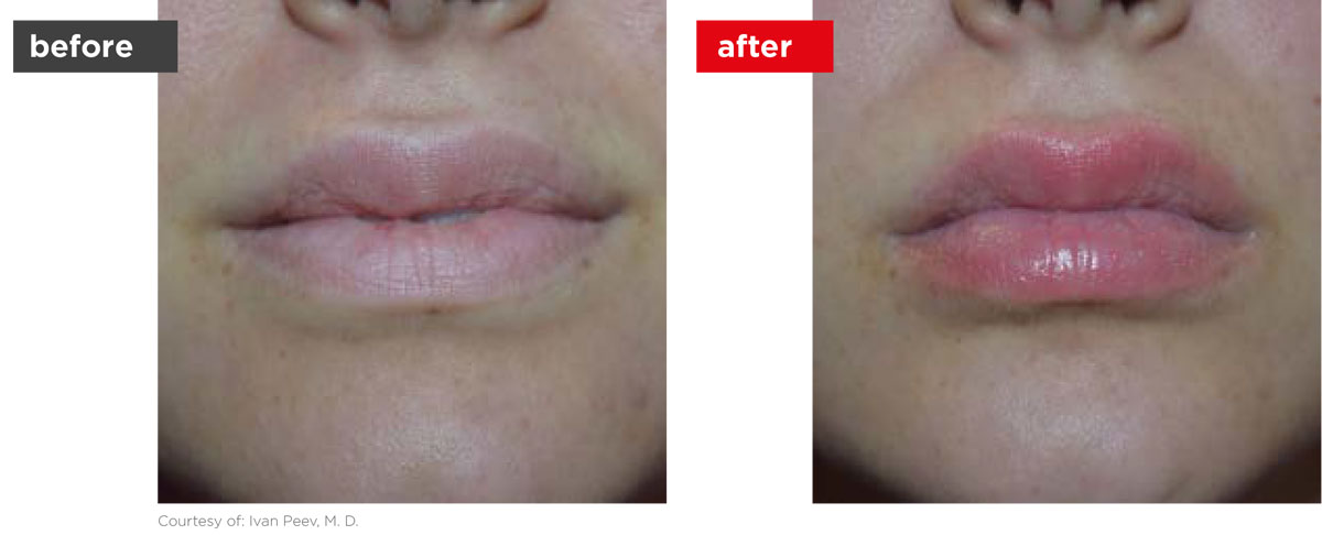 LipLase-Before_After-1 LipLase-Before_After-1