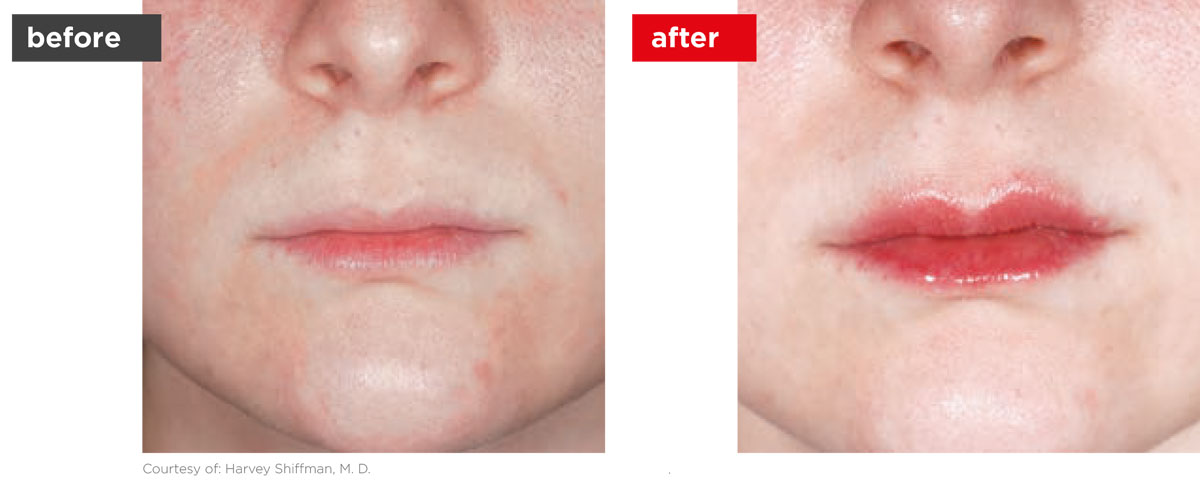 LipLase-Before_After-2 LipLase-Before_After-2