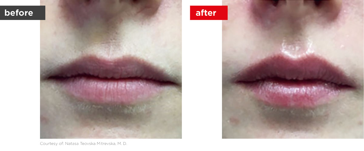 LipLase-Before_After-3 LipLase-Before_After-3