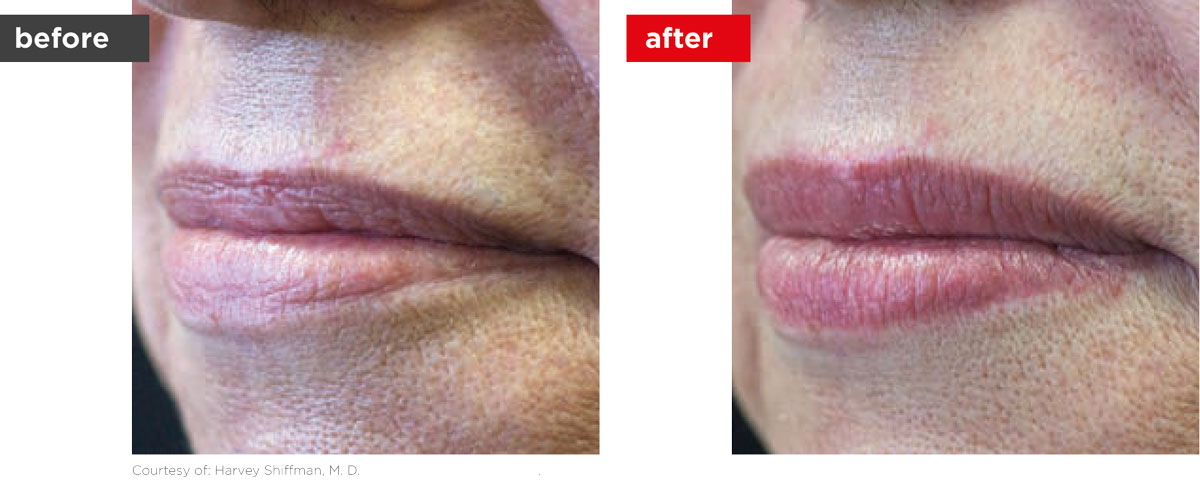 LipLase-Before_After-4 LipLase-Before_After-4