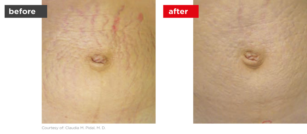Scars-Stretchmarks-Before_Afters-1 Scars-Stretchmarks-Before_Afters-1