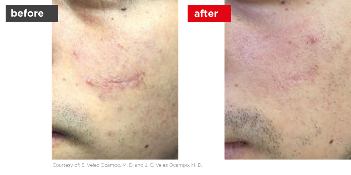 Scars-Stretchmarks-Before_Afters-10 Scars-Stretchmarks-Before_Afters-10