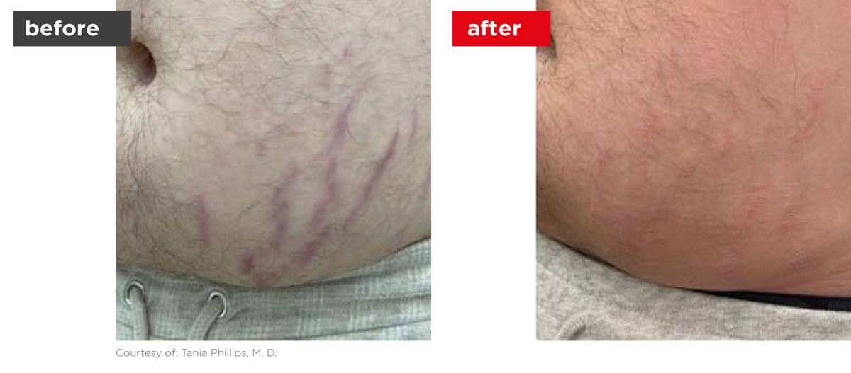 Scars-Stretchmarks-Before_Afters-2 Scars-Stretchmarks-Before_Afters-2