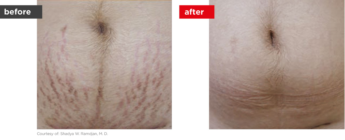 Scars-Stretchmarks-Before_Afters-3 Scars-Stretchmarks-Before_Afters-3