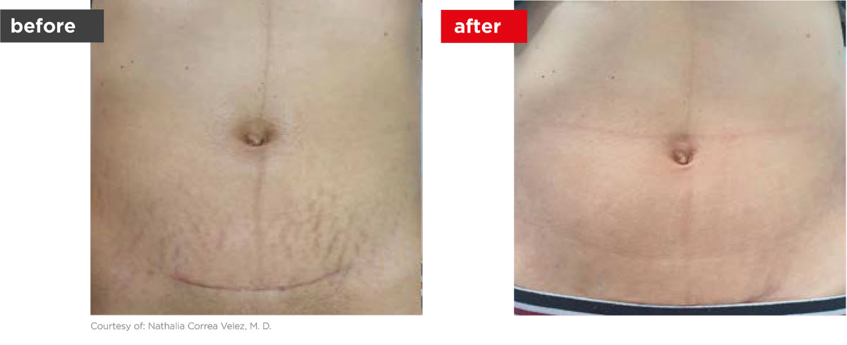 Scars-Stretchmarks-Before_Afters-4 Scars-Stretchmarks-Before_Afters-4