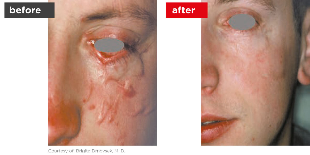 Scars-Stretchmarks-Before_Afters-5 Scars-Stretchmarks-Before_Afters-5