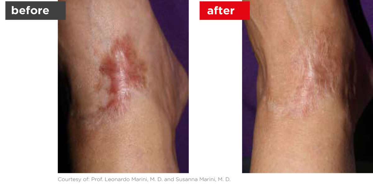 Scars-Stretchmarks-Before_Afters-6 Scars-Stretchmarks-Before_Afters-6