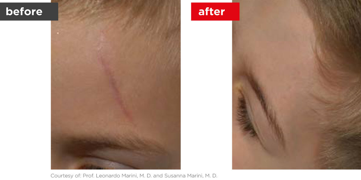 Scars-Stretchmarks-Before_Afters-7 Scars-Stretchmarks-Before_Afters-7