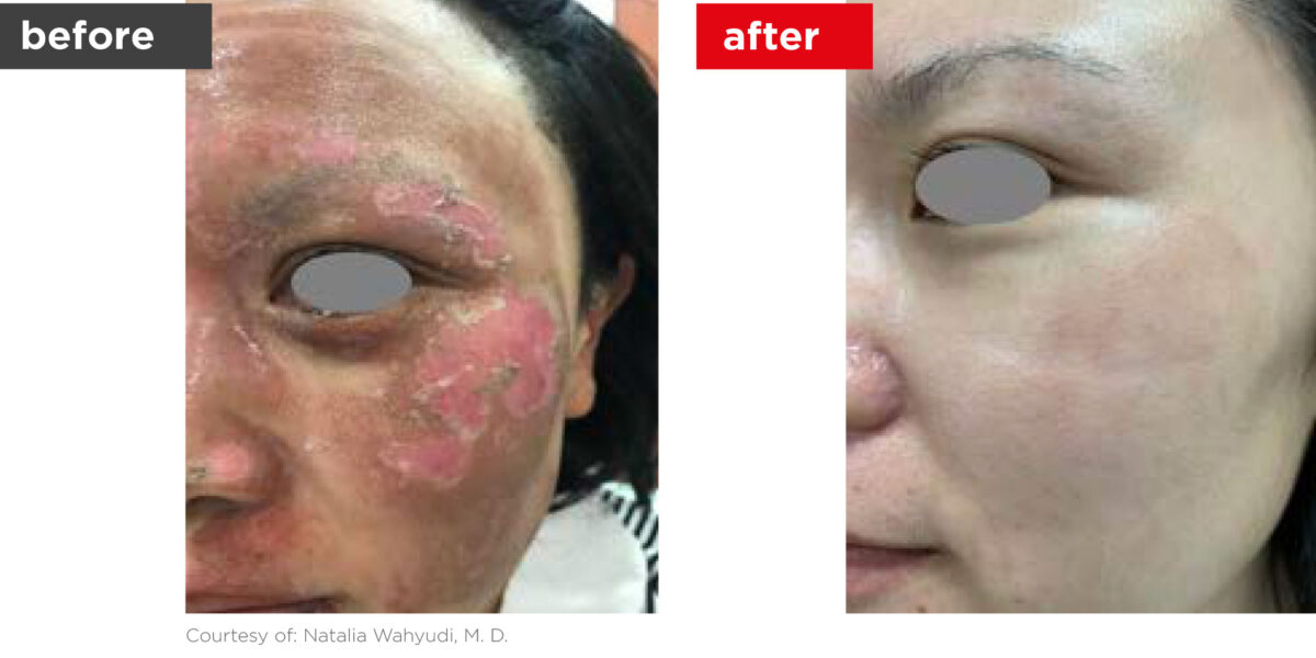 Scars-Stretchmarks-Before_Afters-8 Scars-Stretchmarks-Before_Afters-8