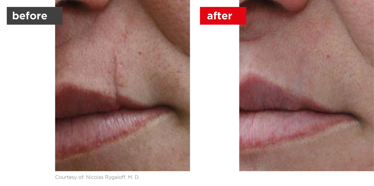 Scars-Stretchmarks-Before_Afters-9 Scars-Stretchmarks-Before_Afters-9