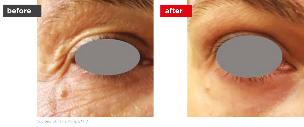 SmoothEye-Before_After-1 SmoothEye-Before_After-1