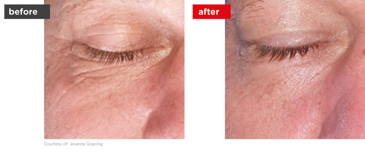 SmoothEye-Before_After-2 SmoothEye-Before_After-2