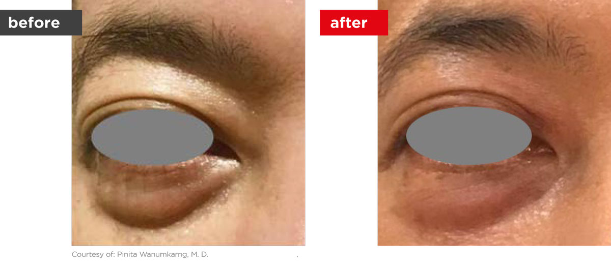 SmoothEye-Before_After-3 SmoothEye-Before_After-3