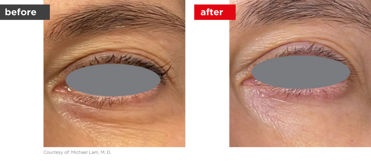 SmoothEye-Before_After-4 SmoothEye-Before_After-4