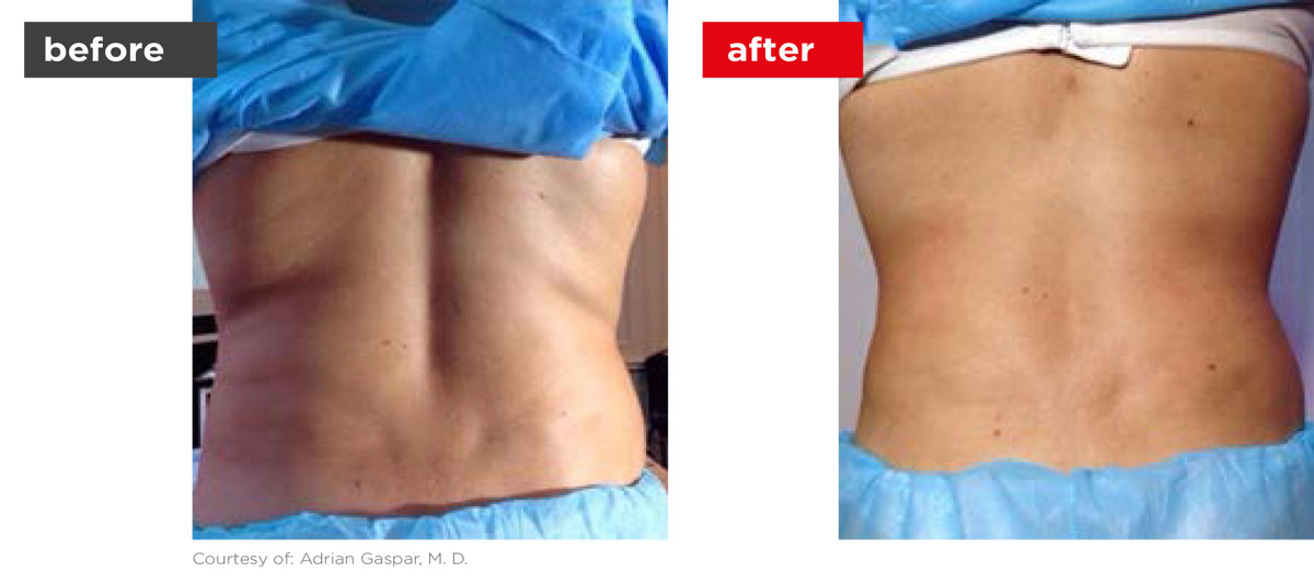 TightSculpting-Before_After-1 TightSculpting-Before_After-1