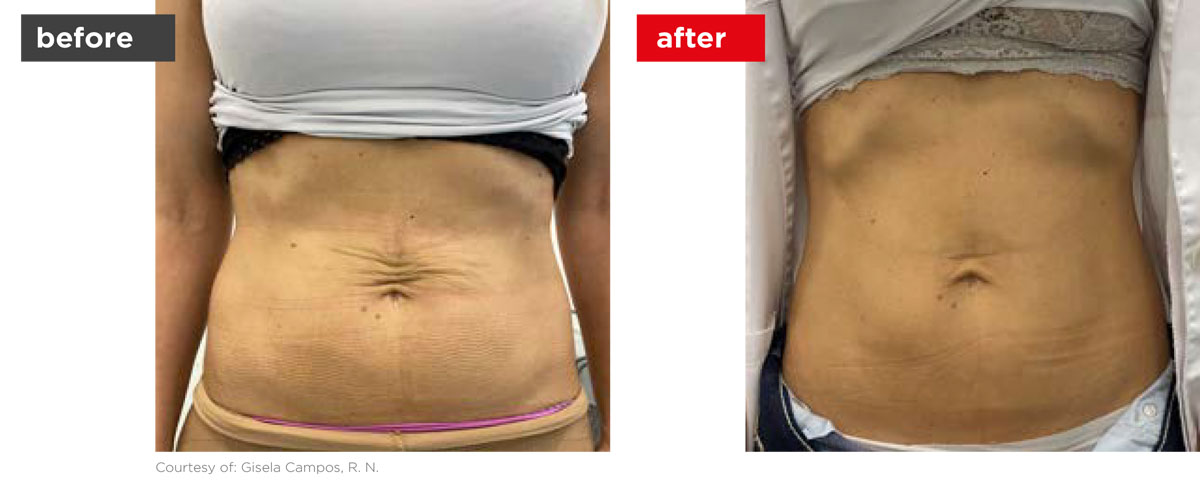 TightSculpting-Before_After-10 TightSculpting-Before_After-10