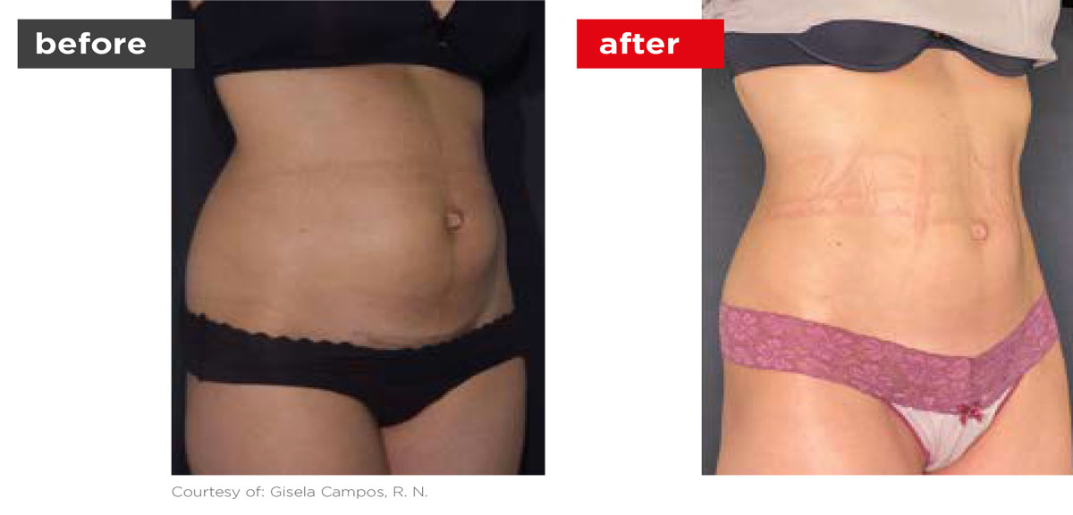 TightSculpting-Before_After-11 TightSculpting-Before_After-11