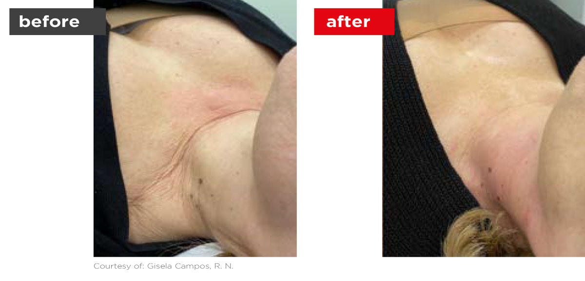 TightSculpting-Before_After-12 TightSculpting-Before_After-12